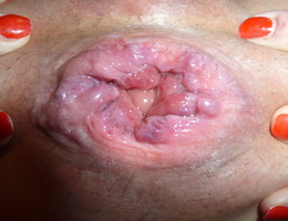 Extreme fisting amateurs gellery Image 4